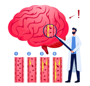 Inflamasi Pengaruhi Kecerdasan